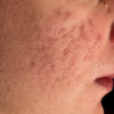 Acne treatment Vienna using non-invasive laser therapy. Removal of acne and scars.